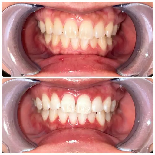 ✨ご新規様限定価格✨15分×2回照射　8800円→1980円🩵