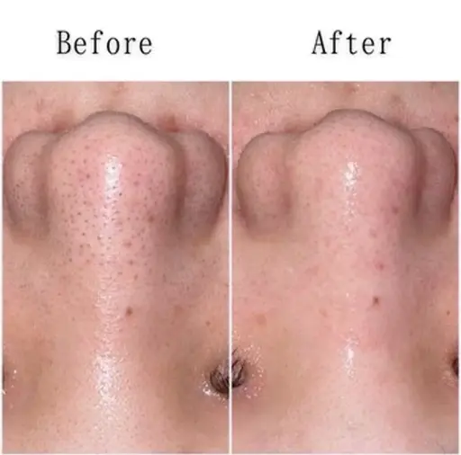 【🎀初回限定🎀】ハイドロ毛穴洗浄✨️黒ずみ除去&つるん肌体験