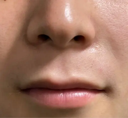 《🔥お試しヒゲ脱毛🔥》メンズ脱毛◆青ヒゲ・剃り残し・トラブルのない清潔感のある肌へ✨ \3850