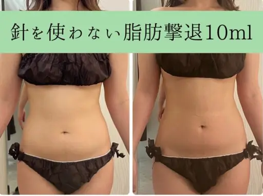 👑人気NO.1👑針を使わない脂肪撃退‼️後戻りゼロ🫶 +ハイパーナイフEX 🔥 【お好きな箇所1部位集中】