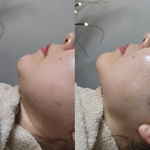 "艶"爆誕ガラス肌コース