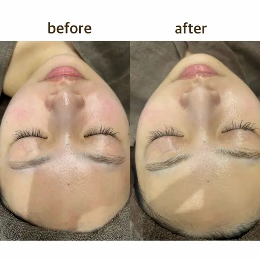 ハーブピーリング🌿剥離なし・ダウンタイムなし