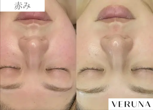 ハーブピーリング剥離なし〈オーダーメイド調合施術〉