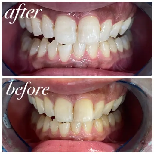 🏫セルフホワイトニング🏫学割‼️初回体験10分×3回　​〜​安心のカウンセリング付き​〜​