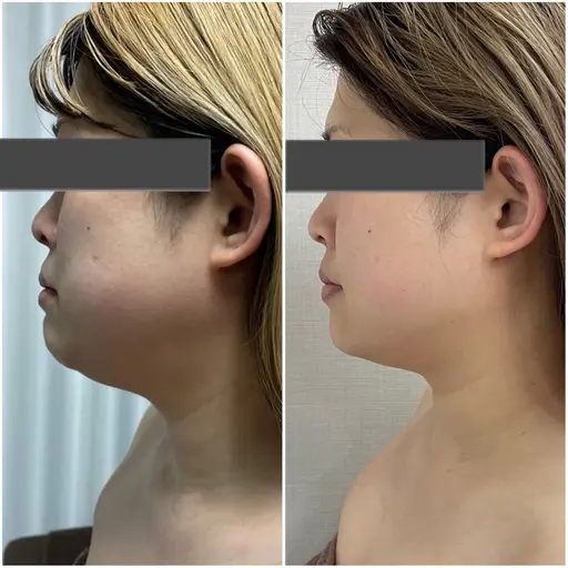 期間限定!先着20名様】究極小顔(マシン×小顔矯正)90min¥18,700→¥1,000