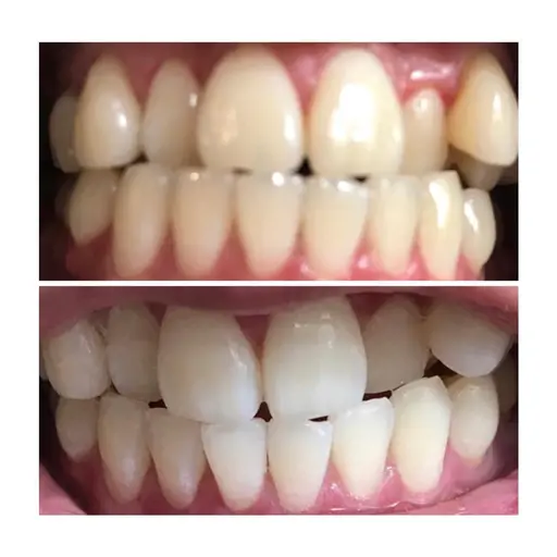 【minimo限定】ハイグレードホワイトニング🦷8分4回照射　結果が目に見える💯