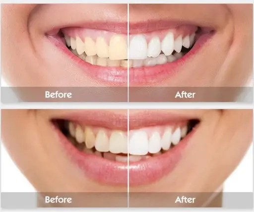 期間限定価格！歯のセルフホワイトニング
