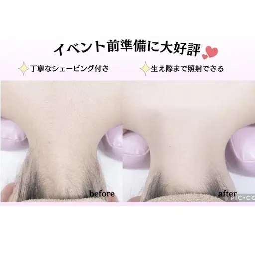 🎓卒業式・新生活応援企画🌸【うなじ脱毛・顔脱毛・美肌エステ】選べるメニュー￥1980