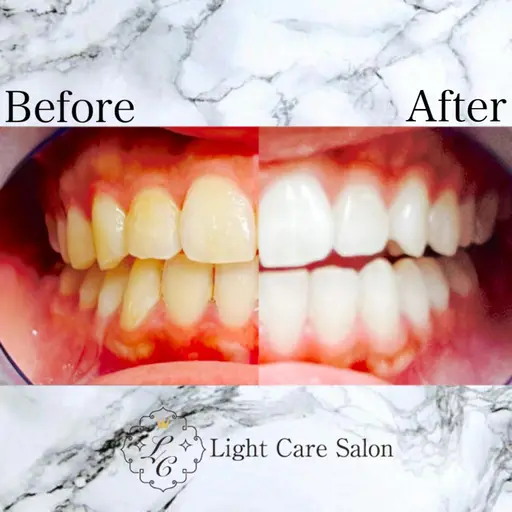 🔹限定2名様🔹✨一番人気✨【🔥圧倒的効果🔥】通常の6倍照射！セルフホワイトニング9,800円🦷✨