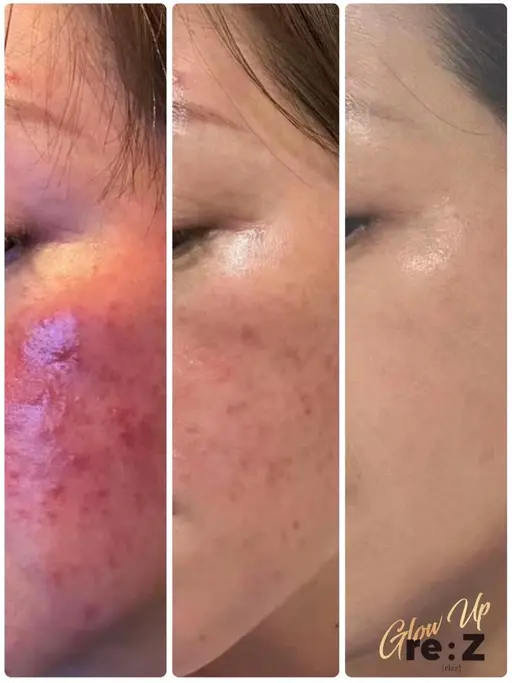 【数名限定🌈】韓国肌質改善🇰🇷天然微細針で内側からつるん肌✨毛穴/ニキビ/シミシワたるみ