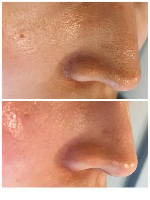 【毛穴洗浄】ピーリング角栓黒ずみ除去!ハイドラ&美容液導入エレクトロポレーション60分💎✨¥22000→