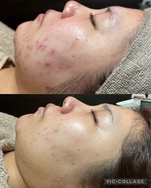 繰り返すニキビ　黒ずみ毛穴　にオススメ🩷🩵剥離なし　REVI陶肌トリートメント（ハーブピーリング）