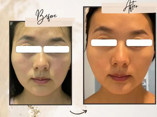 たるみ改善メニュー動画撮影（顔出しなし）