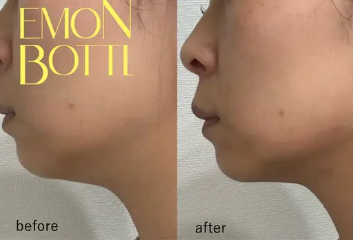 お顔のたるみに！脂肪を撃退レモン🍋ボトル