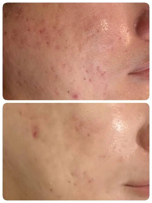 【ニキビケア/凹凸】赤み改善ハーブピーリング/ポレーション導入コース¥5500✨