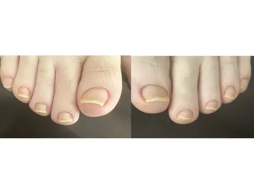 深爪・巻爪カウンセリング　　¥2,000→  無料