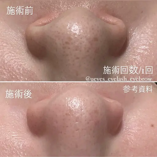 毛穴ハイドロピーリングトリートメント