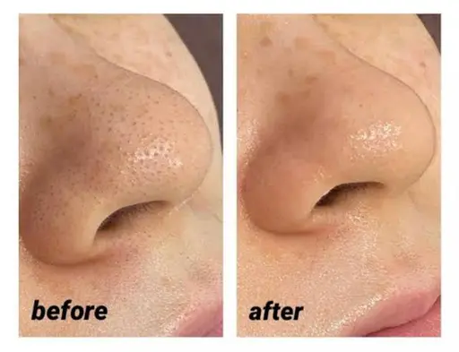 毛穴洗浄(鼻のみ)💖