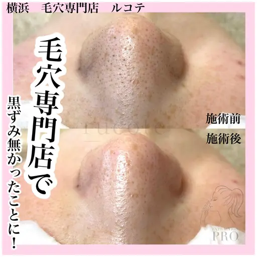 \毛穴スッキリコース/毛穴エクストラクションで黒ずみざらつきを一度でリセット!