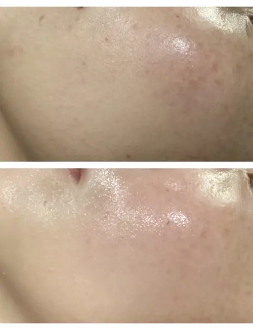 【シミケア/美白】水光肌ホワイトピール/ハイドロリンパ排泄コース¥5500✨