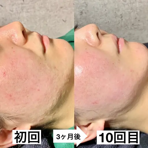 初回限定🌱漢方×ビタミン高級国産ハーブピーリング（剥離なし）どんな肌質にも◎【肌質改善・肌管理】ニキビ、トーンアップ