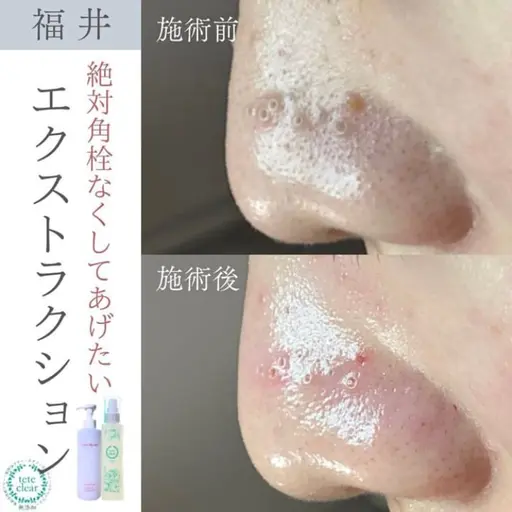 【ミニモ限定】毛穴エクストラクション｜毛穴の黒ずみ・開き毛穴・凹凸※2回目以降割引有り 通常¥12800