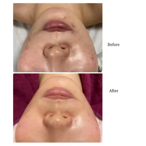 最短ニキビケア‼︎ニキビ跡悩みに15万本のイノスピキュールで細胞から元気にVOSサロンケア✨