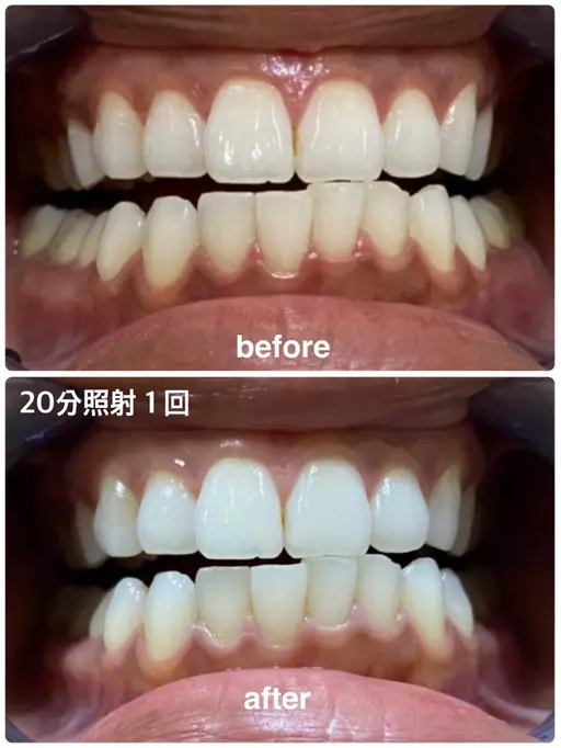 【74%off】ホワイトニング40分コース