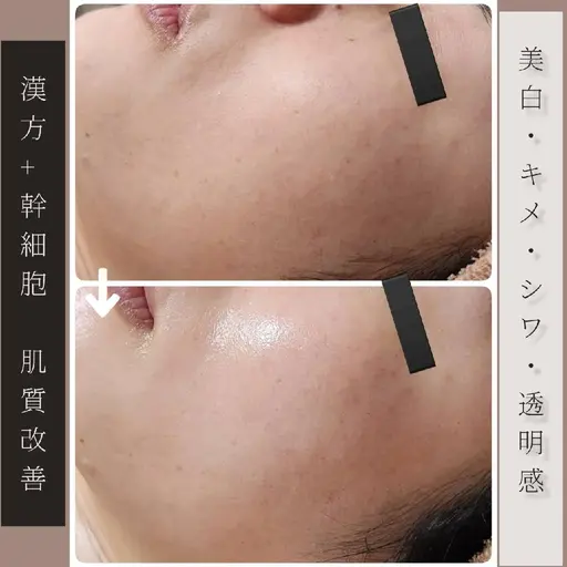 【憧れのツルツル陶器肌】剥離なし肌質改善ハーブピーリング