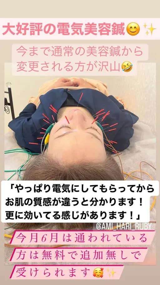 【頭皮からリフトアップ‼️電気美容鍼】頭皮鍼＋リフトアップ美容鍼＋EMS機で引き上げ+肩ほぐし＋小顔リンパマッサージ