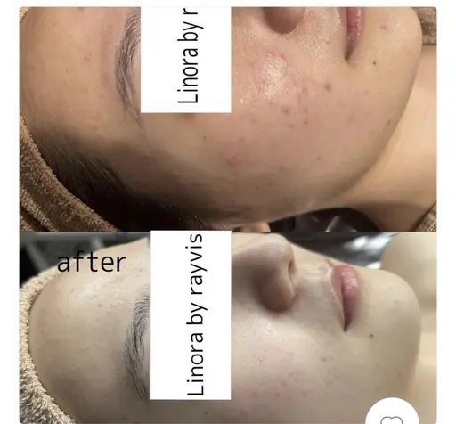 19日限定❄️【白玉ピーリング】最強美白ケアを体感クリニックいらず⁉シミ、毛穴、たるみ、シワをダウンタイムゼロで改善🤍