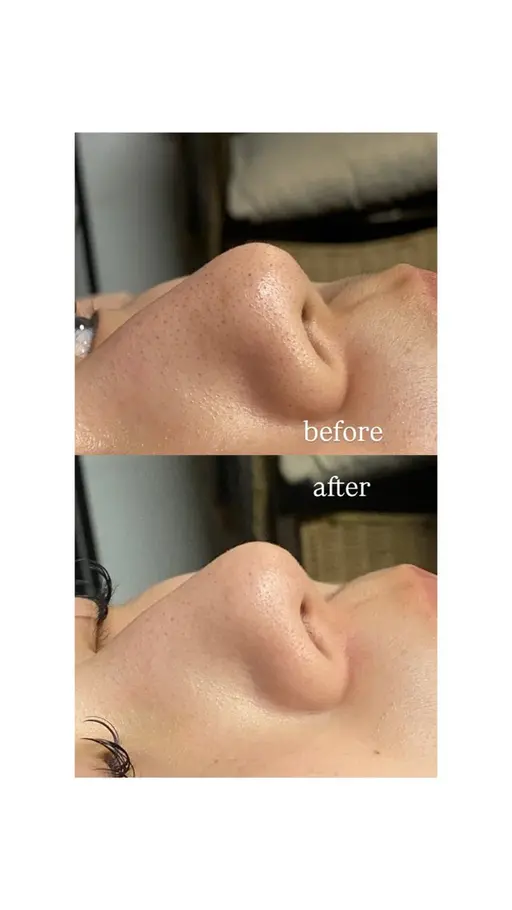 【毛穴レス洗浄　3300円】　黒ずみ、角栓をごっそり除去します✨👃🏼※鼻のみとなります