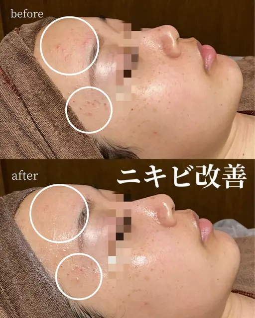 【モニター様大募集✨️】肌荒れ/赤ニキビ/ニキビ跡 でお悩みの方におすすめトリートメント🎶