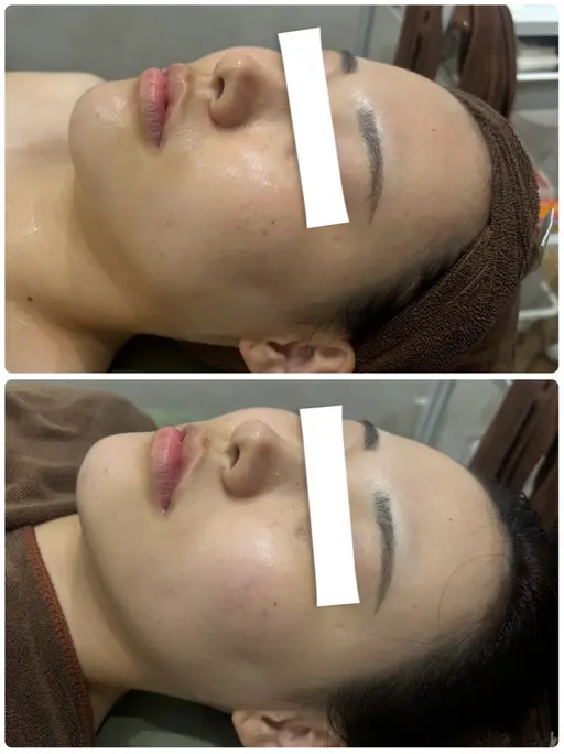 大人気❣️小顔フェイシャル❣️‪ 【お顔マッサージ付き✨️】‼️11月末まで‼️