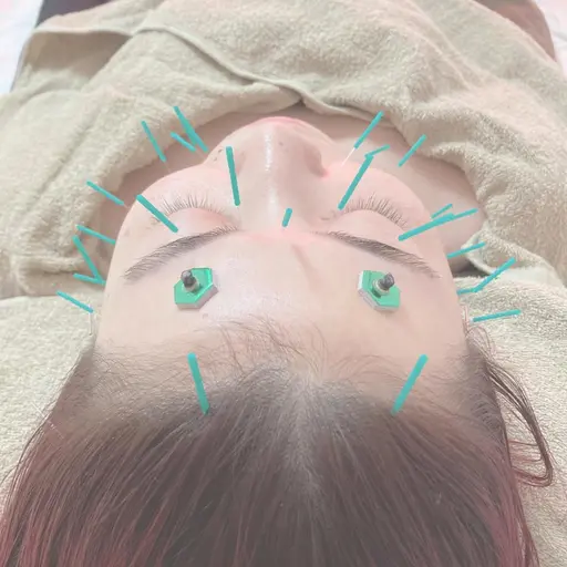 🔰✨お顔スッキリ✨　　　　　　　　　　　　　　　　　美容鍼ノーマルケアコース（お顔のみ）