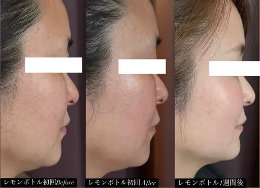 韓国発🇰🇷大人気小顔リフト【二重あご/口ゴボ/たるみ/口横ポニョ】小顔矯正+韓国リフト¥10800