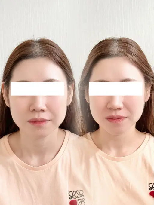 小顔フェイシャルエステ/ 小顔矯正