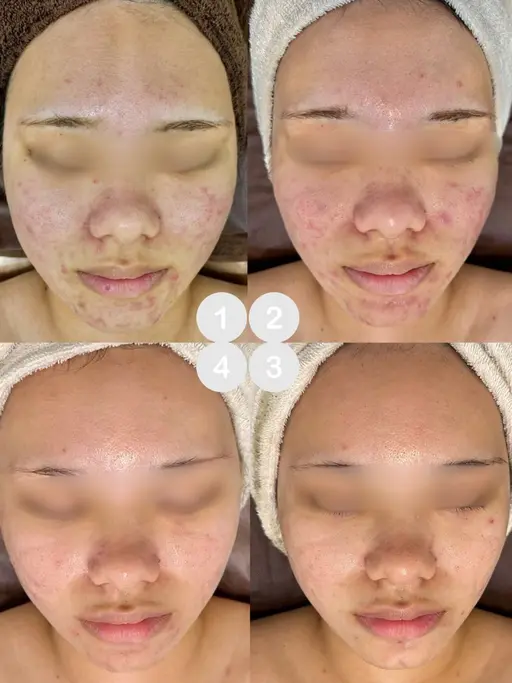 肌質改善ハーブ🌿ミニモ限定価格！