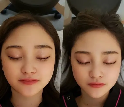 【美容鍼×小顔矯正✨】すっぴん革命💎むくみゼロ小顔✨