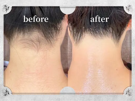 期間限定！【男女OK】うなじ脱毛/¥1500☆★30分