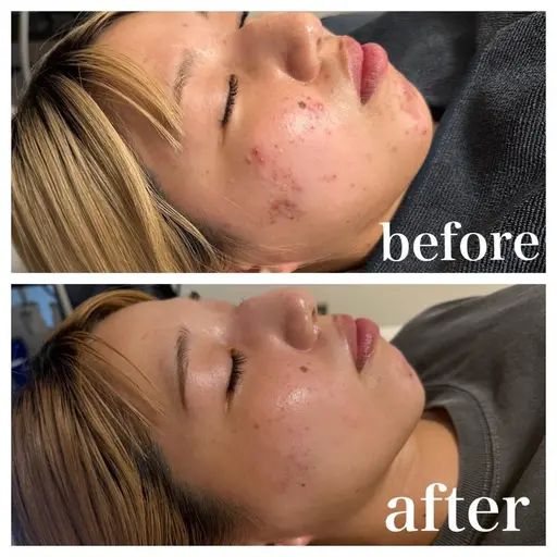 🌿1日2組限定🌿体験キャンペーン！国産針ハーブピーリング　¥15,400→ 《¥4,400》