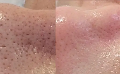 【水光肌】ハーブピーリング✨剥離なし🕛ダウンタイムなし！ニキビ跡、シミ、くすみが気になる方🫧