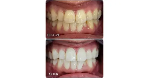 3名様限定💦早い者勝ち🔥ホワイトニング🦷半年間通い放題✨🦷(現金払い)