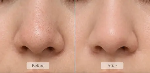 【いちご鼻撃退】憧れの美肌小顔へ✨ Vライン骨格小顔+つるつるタマゴ肌へ<毛穴/テカリ/ハリ/肌荒れ/乾燥>