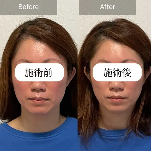 🎀ミニモ限定🎀頭蓋骨・小顔矯正