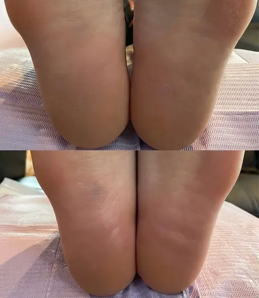 🌻夏に向けてツルツル素足👣⸒韓国式足裏角質ケア THESSAKPLANING🦶🏻🫧￥3000~