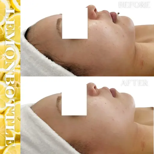 12月ご来店の方限定🍋クリニックレベルの脂肪コントロール✨️痛み・ダウンタイムなし！‼️【頬・フェイスライン】