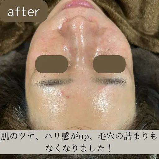 【大分最安値！人気No.1】シミ、シワ、たるみが本気で気になる方へ！効果が分かりやすい、剥離しないピーリング