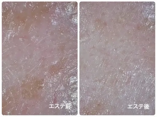 【学生限定/毎月3名様】リフトアップ/美白/毛穴引き締め効果あり🫧超音波エステ