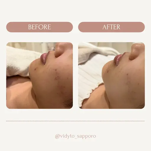 学割U24🫧韓国モデリングパック体験🫧周りに差をつけお肌を綺麗にっ♡ツヤ肌/美毛穴即体感✨【ニキビ/跡/毛穴】